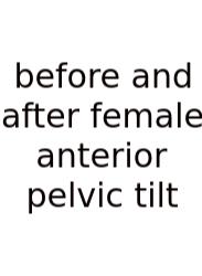 Before And After Female Anterior Pelvic Tilt