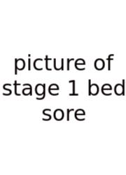 Picture Of Stage 1 Bed Sore