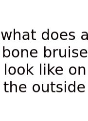 What Does A Bone Bruise Look Like On The Outside