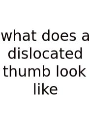 What Does A Dislocated Thumb Look Like